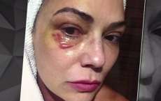 Imagem de hematoma no rosto de Luiza Brunet &eacute; revelada