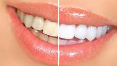 Saiba quais alimentos escurecem os dentes