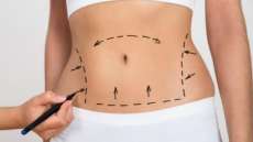 Mulheres que fazem abdominoplastia t&ecirc;m uma perda de peso dur&aacute;vel, afirma estudo
