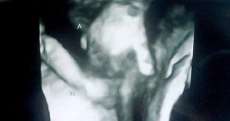 Ultrassom: beb&ecirc; com poucas chances de sobreviver aparece de m&atilde;os dadas com irm&atilde;. Veja v&iacute;deo