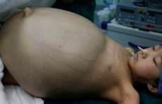 Menina de 12 anos retira tumor de 15kg, veja antes e depois