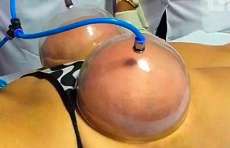 T&eacute;cnica de suc&ccedil;&atilde;o para empinar bumbum pode causar isquemia e necrose