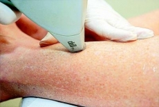 Depila&ccedil;&atilde;o Definitiva a Laser - A melhor solu&ccedil;&atilde;o para remo&ccedil;&atilde;o dos pelos indesejados