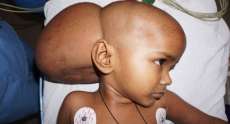 M&eacute;dicos retiram tumor raro do tamanho de bola de futebol de menina