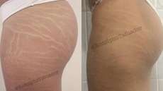 Tatuador cria t&eacute;cnica que camufla marcas de estrias e faz sucesso na web
