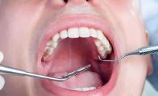 Molar &eacute; o dente que mais d&aacute; tratamento de canal, diz especialista