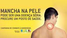 Pinh&atilde;o - Secretaria de sa&uacute;de faz campanha contra a Hansen&iacute;ase
