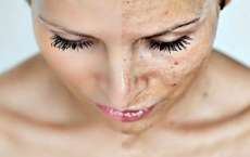 Dermatologista indica tecnologia laser para tratamento de melasma