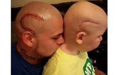 Pai faz tatuagem id&ecirc;ntica &agrave; cicatriz de filho com tumor cerebral