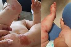 M&atilde;e de beb&ecirc; que contraiu herpes alerta para que visitas evitem beijos nos pequenos