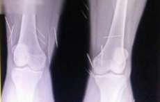 M&eacute;dicos descobrem agulhas em corpo de mulher que se diz v&iacute;tima de magia negra