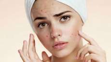 Perguntas indiscretas que n&atilde;o devem ser feitas para quem tem acne