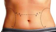 Procedimentos combinados aumentam riscos da abdominoplastia; saiba mais