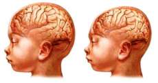 Casos de microcefalia remetem ao trauma da s&iacute;ndrome da talidomida nos anos 60