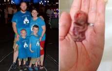Ap&oacute;s sofrer aborto espont&acirc;neo, m&atilde;e compartilha foto do feto