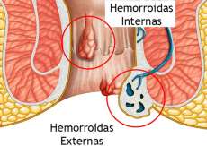 Todo mundo tem hemorroida; especialista explica a causa