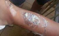 Mãe tenta remover tatuagem de perna de bebê com fogo e acaba presa