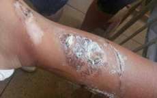 M&atilde;e tenta remover tatuagem de perna de beb&ecirc; com fogo e acaba presa