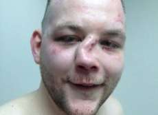 Lutador de MMA impressiona ap&oacute;s publicar foto de nariz totalmente desfigurado por nocaute